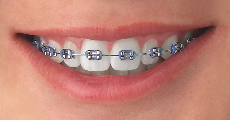 Engineering-Straighter-Teeth