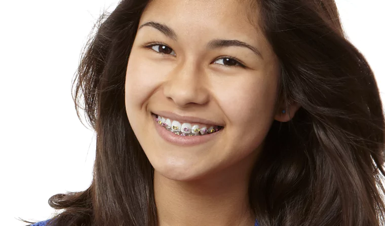 The-Value-of-Conventional-Braces