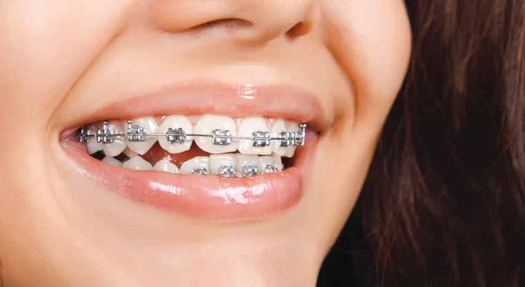 dental-braces